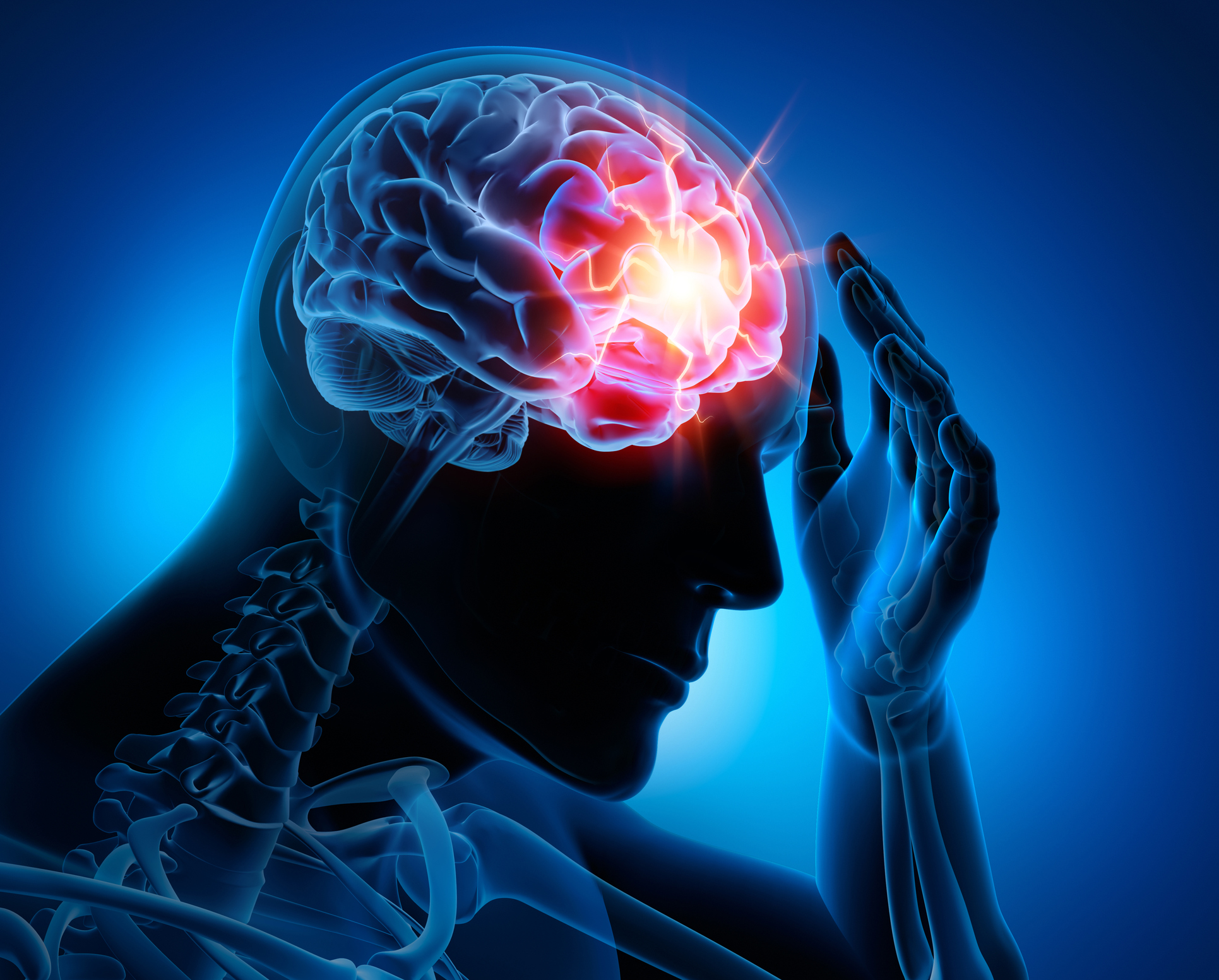 What Is Hemiplegia?